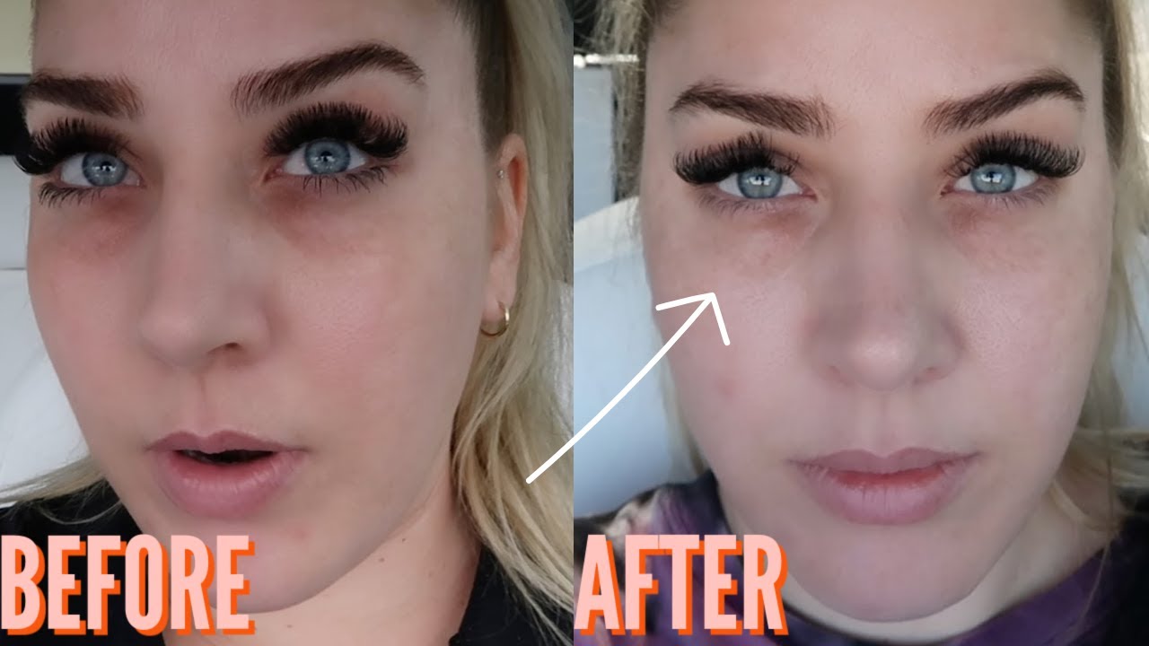 MICRONEEDLING WITH PRP BEFORE AND AFTER//GET RID OF DARK CIRCLES AND VOLUME LOSS UNDER YOUR EYES!
