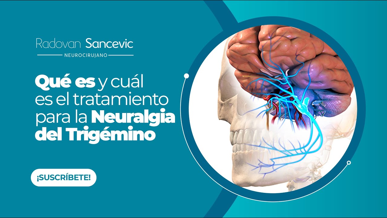 ¿Qué es y cuál es el tratamiento para la NEURALGIA DEL TRIGÉMINO? - Dr. Radovan Sancevic