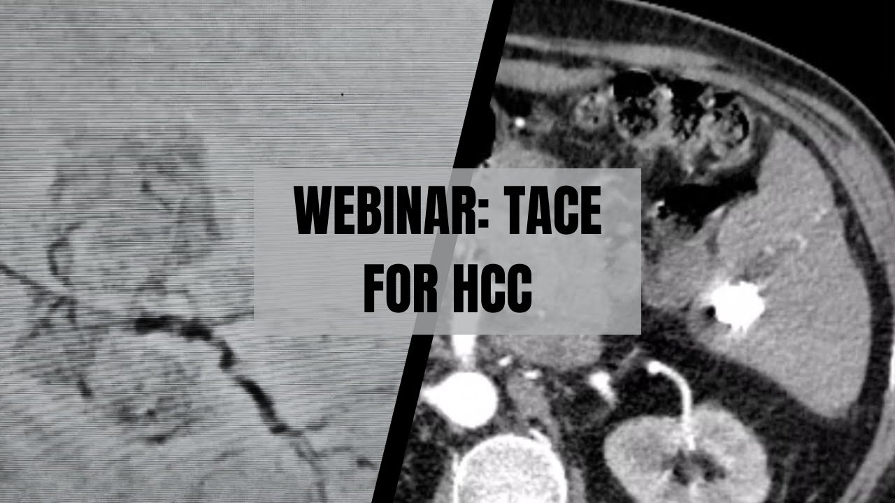Transarterial Chemoembolization (TACE) for Hepatocellular Carcinoma