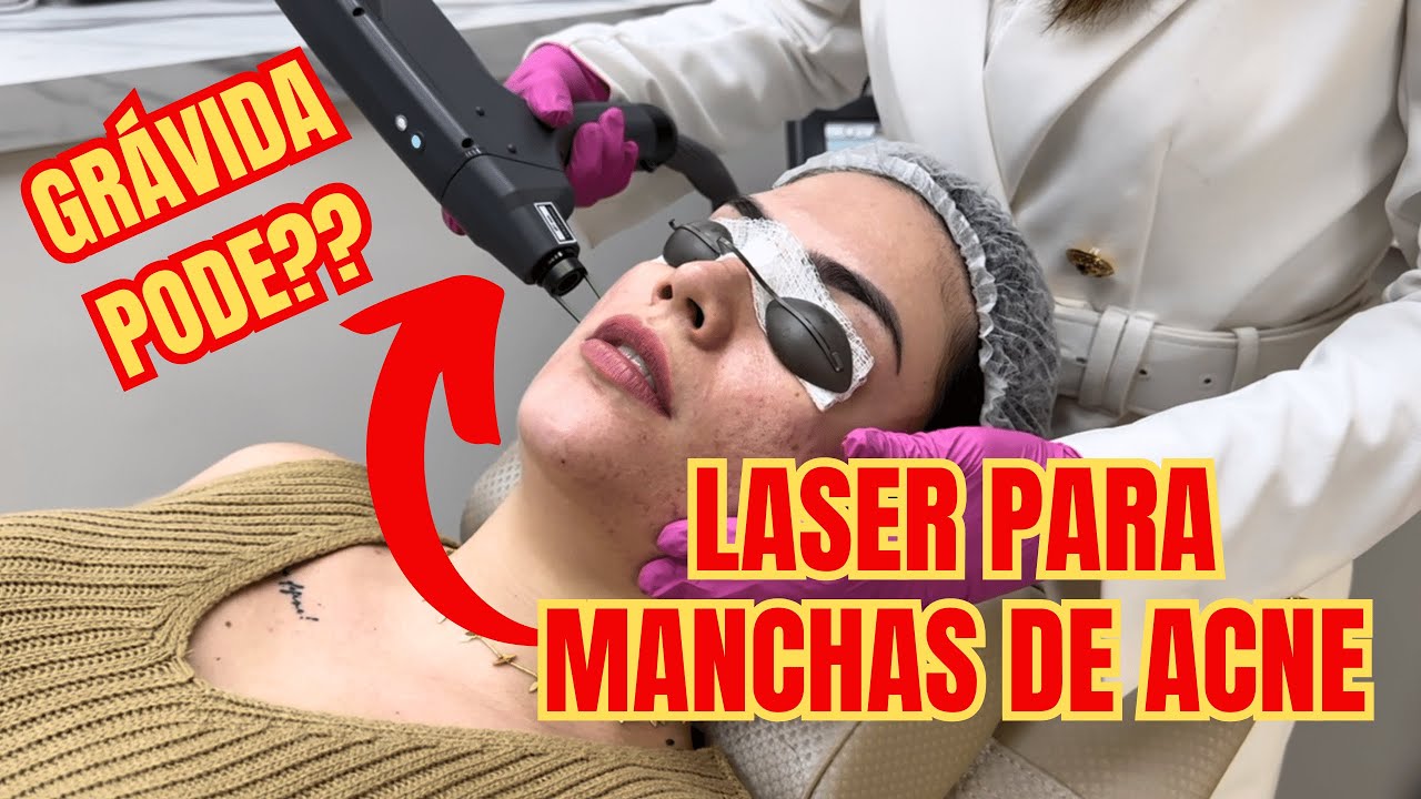 LASER PARA MANCHAS DE ACNE EM GRÁVIDA: PODE OU NÃO PODE?