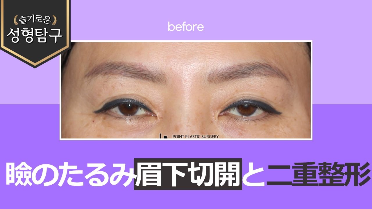 まぶたのたるみ解消、眉下切開と二重整形症例