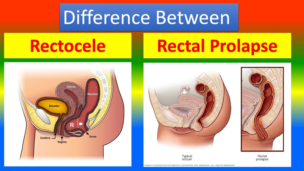 Difference Between Rectocele and Rectal Prolapse