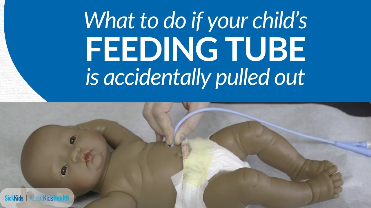 What to do if your child's G or GJ tube is accidentally pulled out | AboutKidsHealth at SickKids