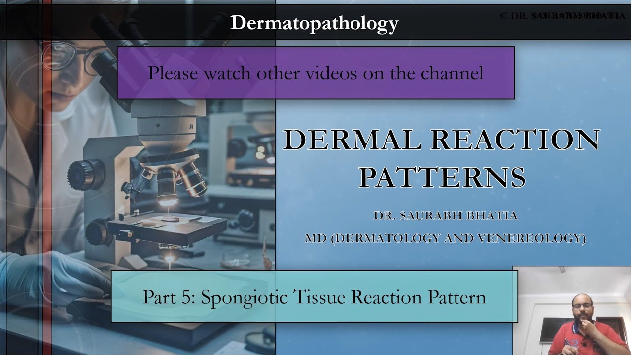 Dermatopathology - V - Spongiotic Tissue Reaction Pattern