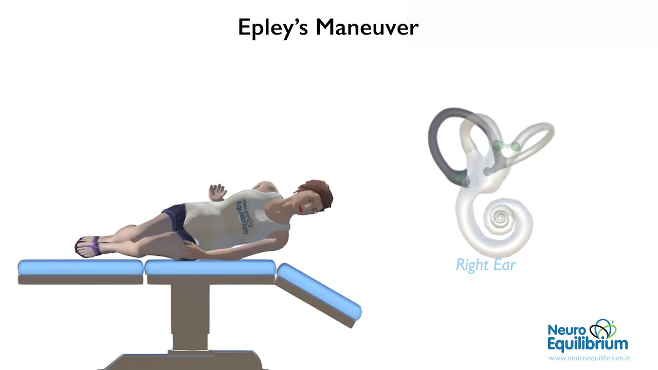Epley Maneuver to Treat BPPV Vertigo: Step-by-Step Guide for Quick Relief