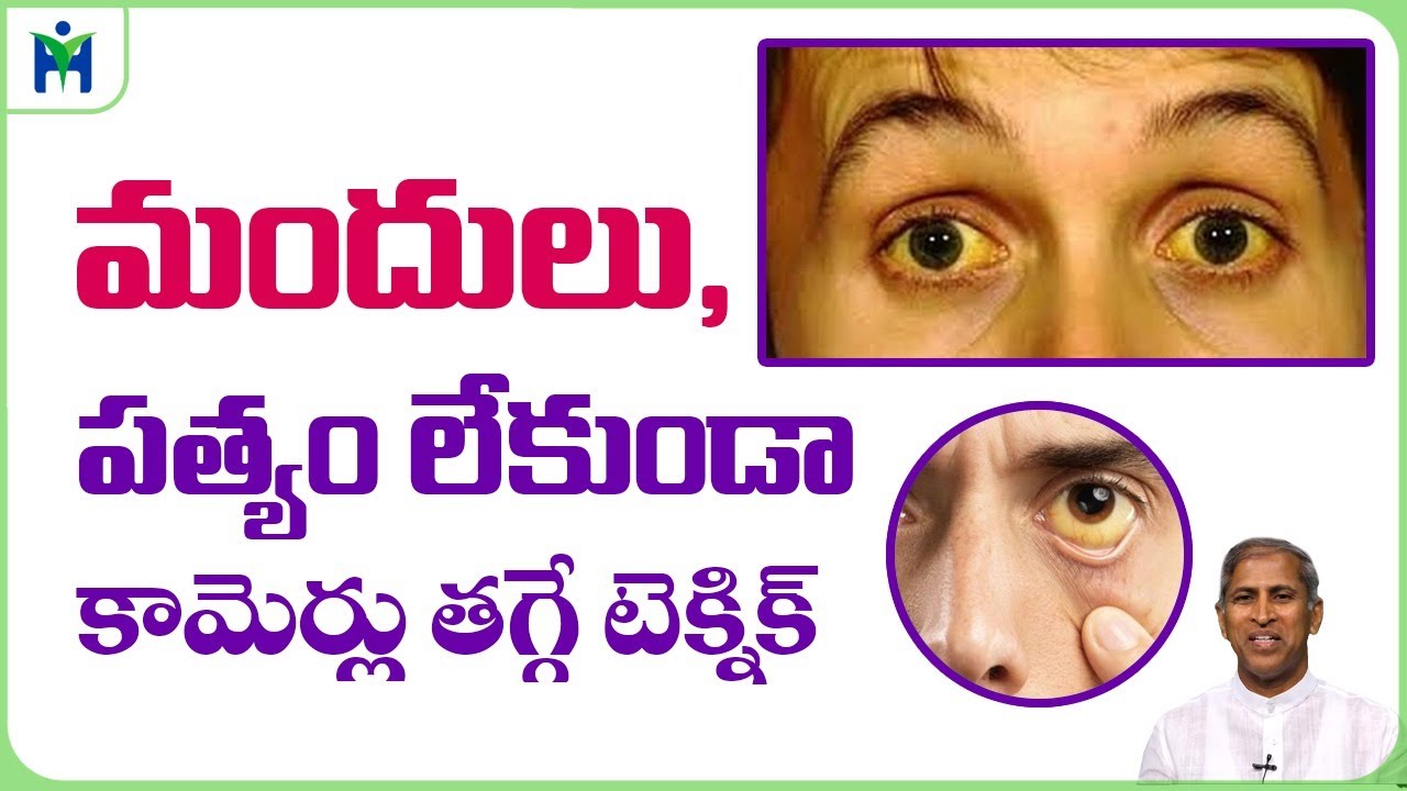 కామెర్లు మందులు లేకుండా తగ్గించుకోవటం ఎలా|Manthena Satyanarayana Raju| Health Mantra|
