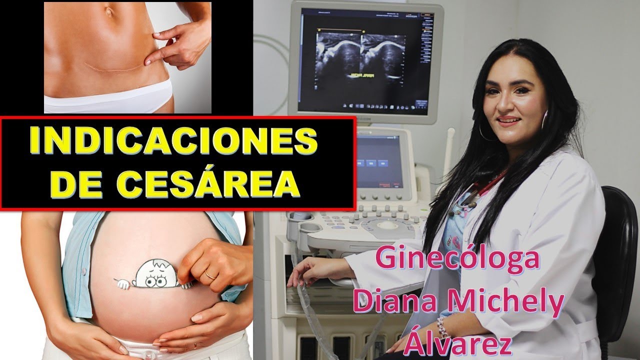 CESAREA, ¿CUANDO ESTA INDICADA?, POR GINECOLOGA DIANA ALVAREZ