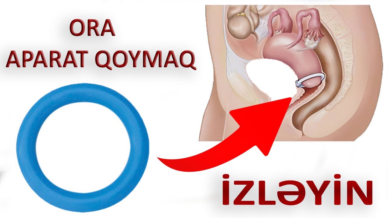 Uşaqlıq yoluna aparat qoymaq - QADINLAR İZLƏYİN!