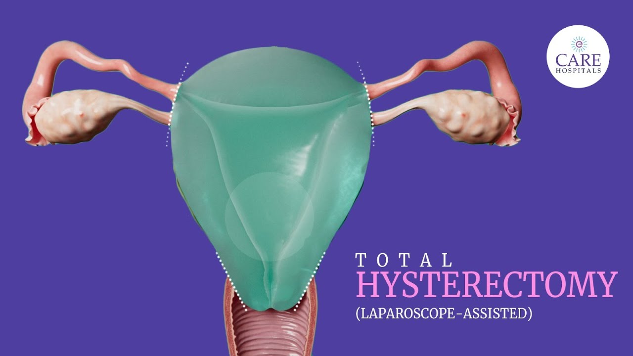 How is Total Hysterectomy done? - The Ultimate Guide | CARE Hospitals