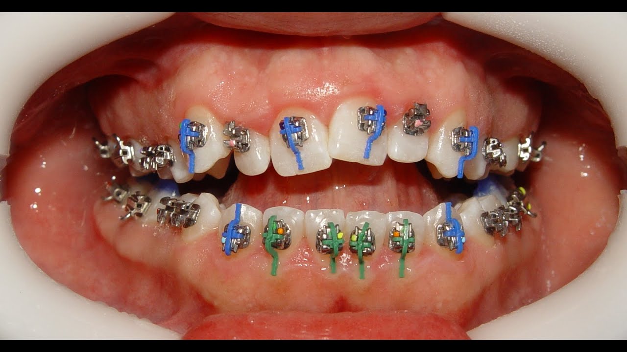 Orthodontic Treatment of Anterior Open Bite - Mahmoud 22yrs