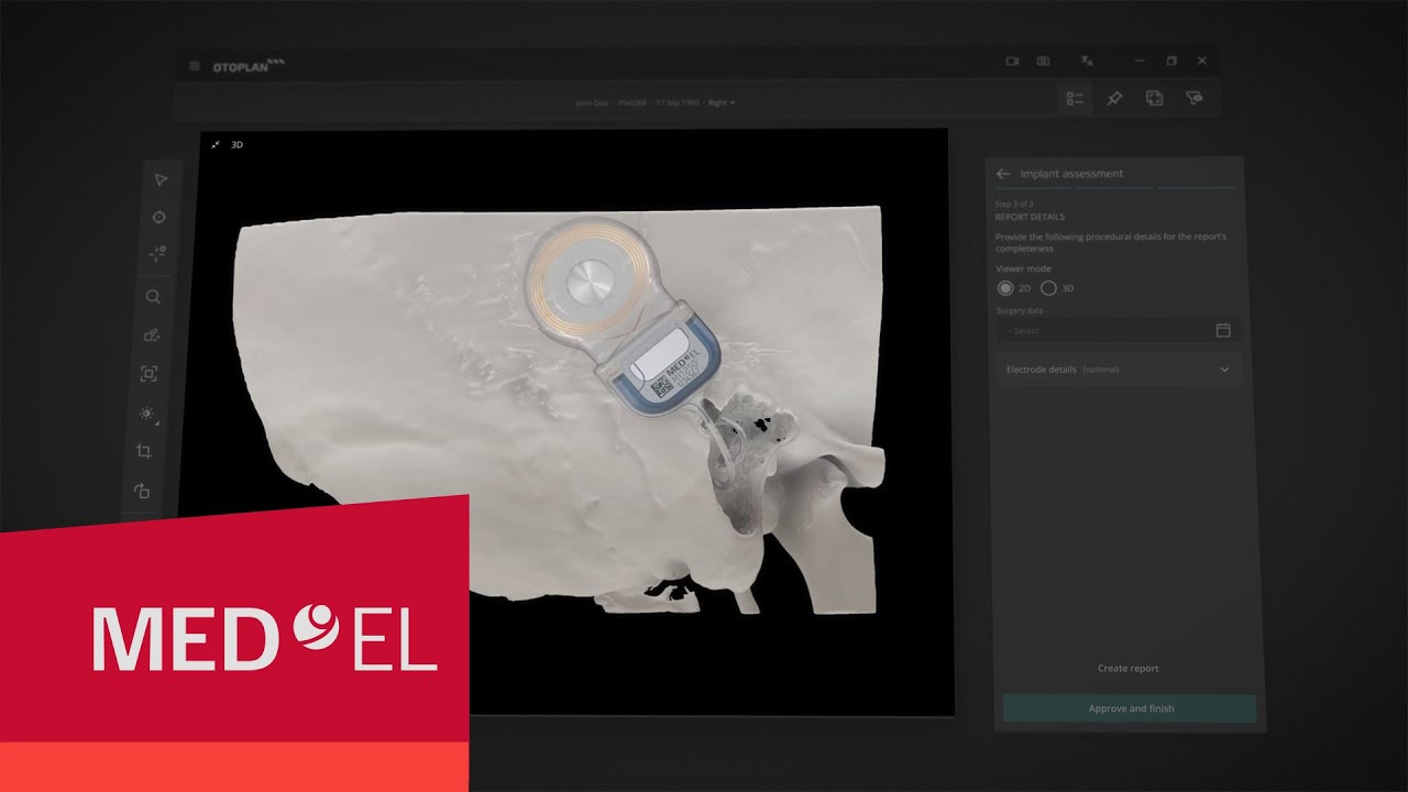 OTOPLAN: Streamlined, Individualized Otological Surgery | MED-EL