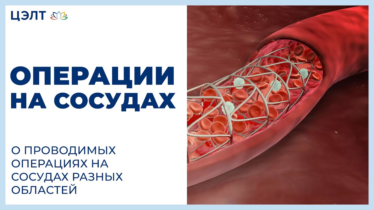 Операции на сосудах. О проводимых операциях на сосудах разных областей