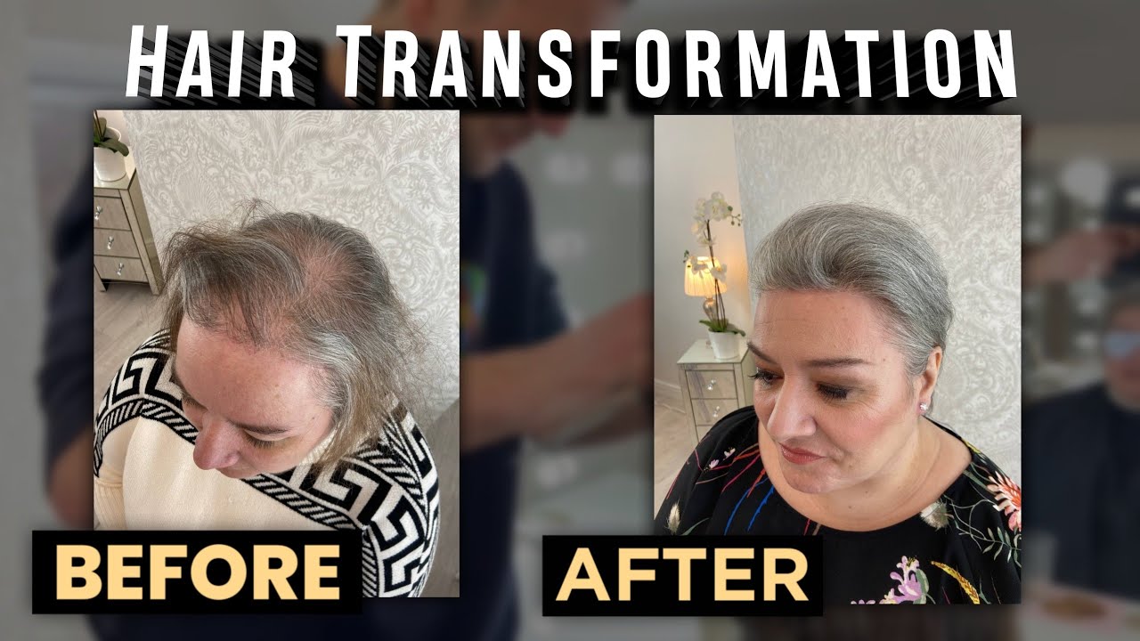 Hair Transformation | Non Surgical Hair Replacement System