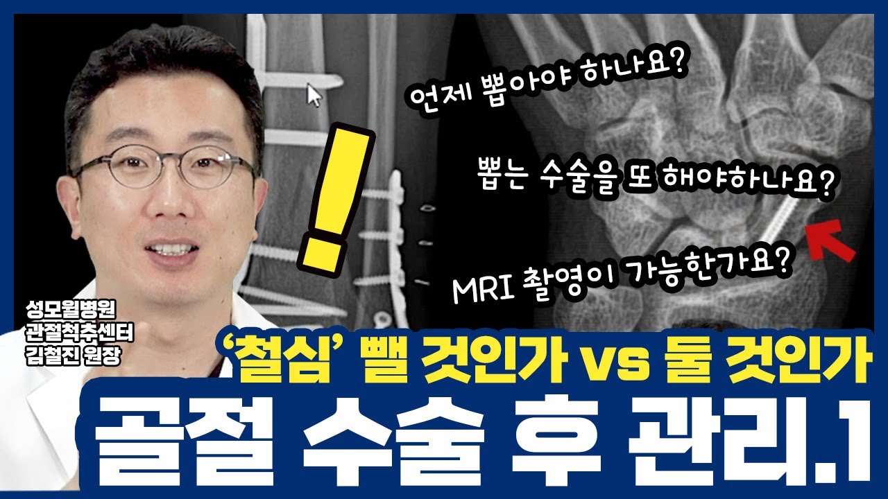 나사못과 쇠판, 뺄 것인가 둘 것인가! 철심 제거 Part 1 (성남 성모윌병원)