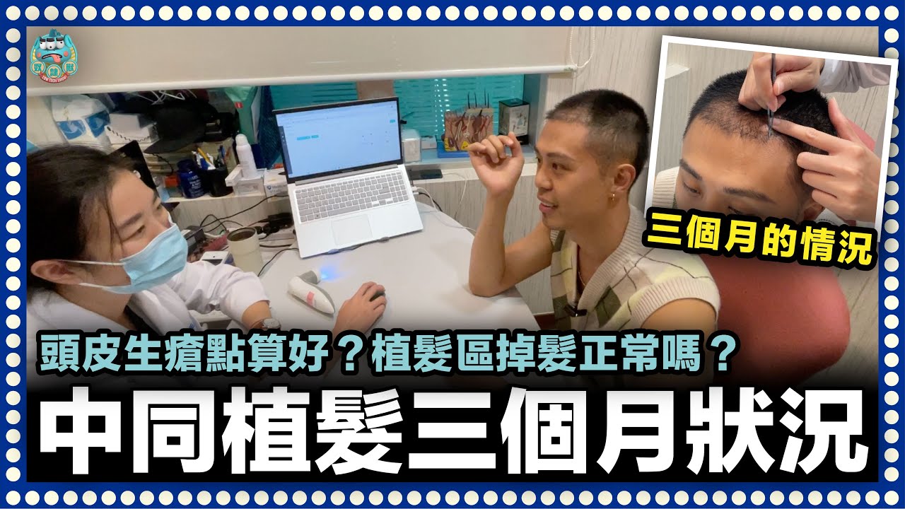 [實錄] 中同朋友植髮後三個月現況實錄！頭髮掉落正常嗎？生頭瘡點算好？｜雍禾植髮