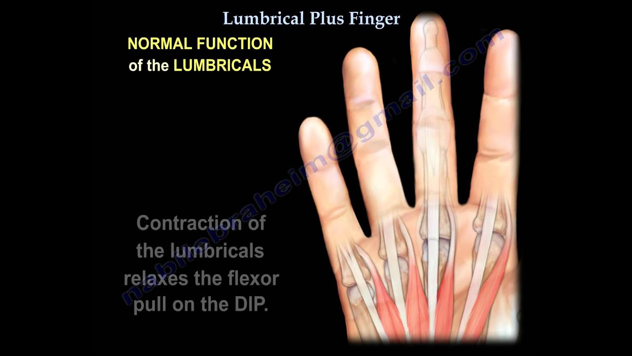Lumbrical Plus Finger - Everything You Need To Know - Dr. Nabil Ebraheim