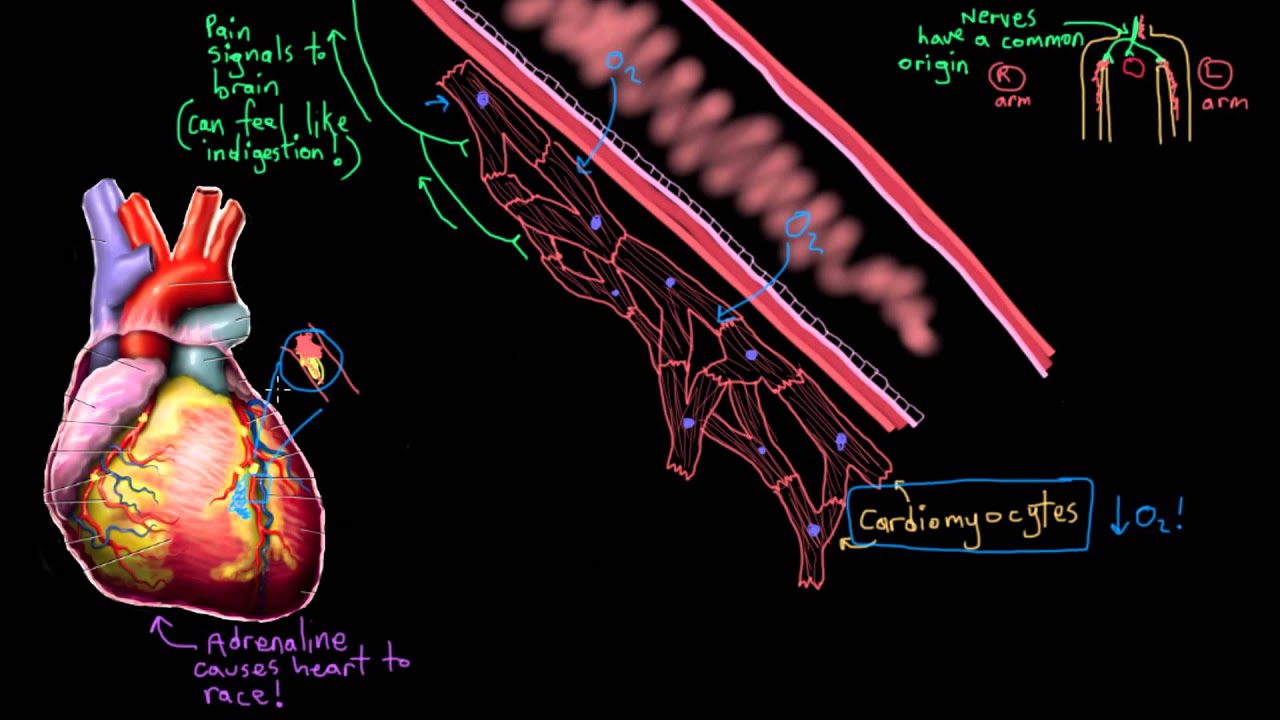 Академия Хана — Патофизиология острого инфаркта миокарда (сердечного приступа)
