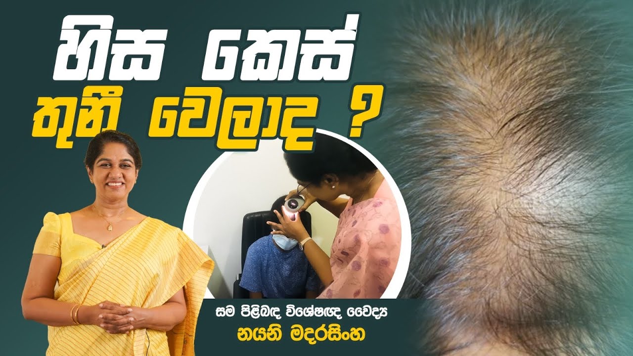 Female Pattern Hair Loss | Hair Growth Tips in Sinhala | Dr Nayani Madarasinghe