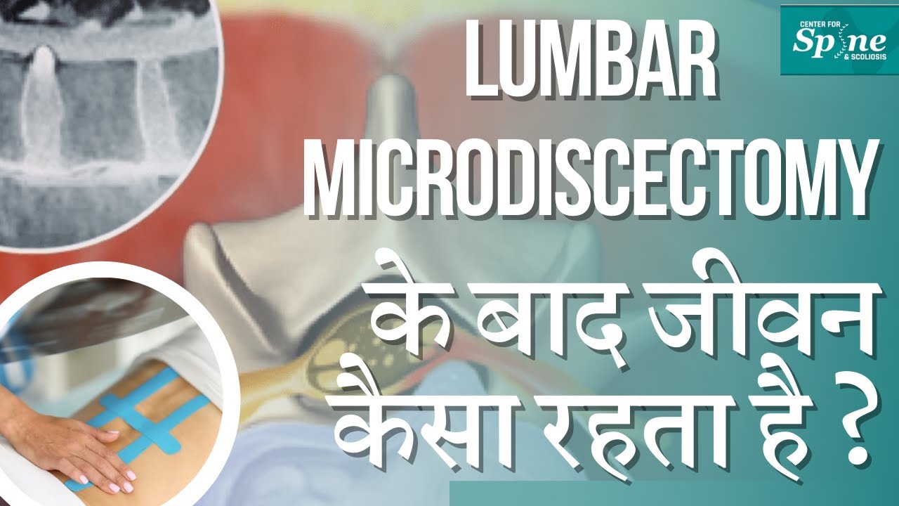 Lumbar Microdiscectomy के बाद मरीज़ का जीवन कैसा रहता है? Recovery after Spine Surgery info in Hindi