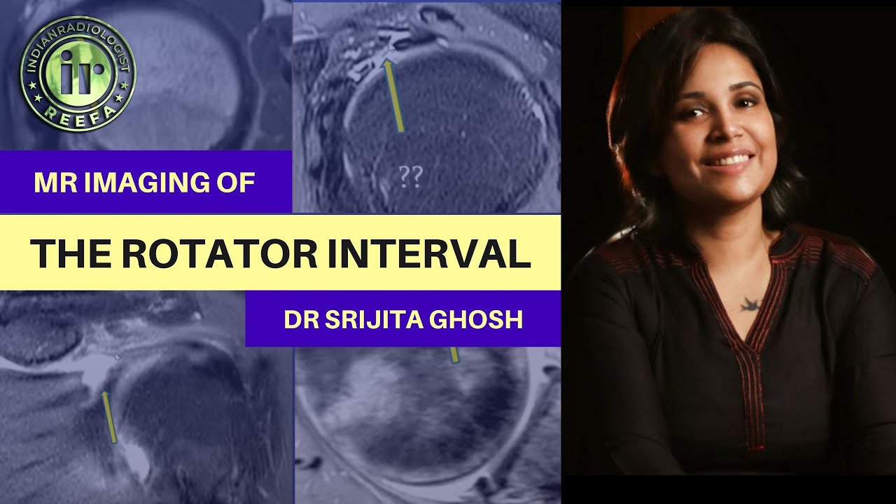 MRI SHOULDER | MRI OF ROTATOR INTERVAL | DR SRIJITA GHOSH | ANATOMY & PATHOLOGIES | BICEPS PULLEY |