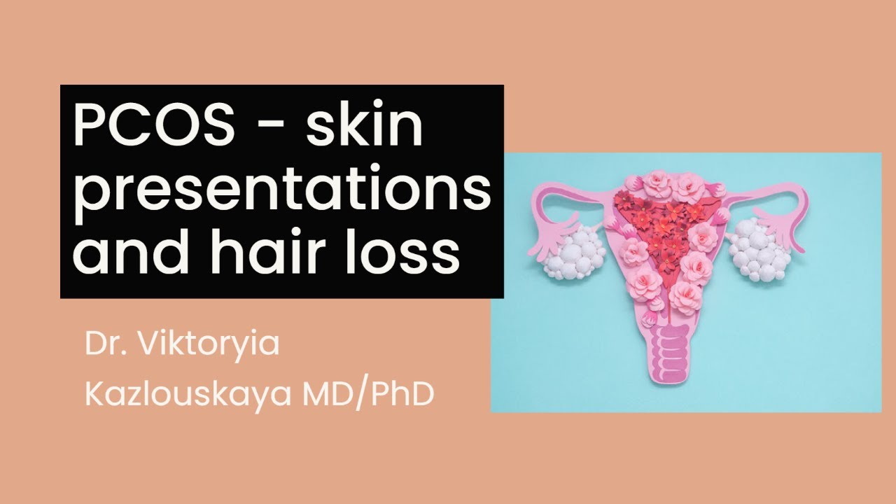PCOS - skin presentations and hair loss