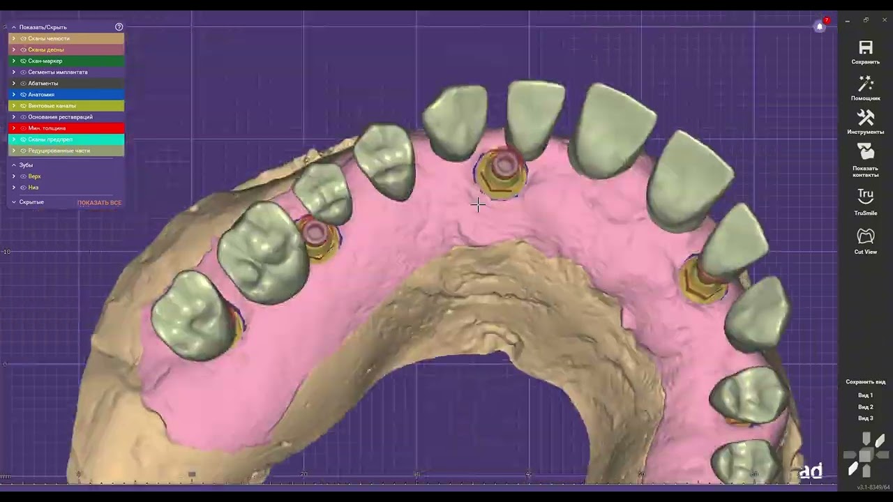 Exocad How prefect big total work can you make with multi units dentium.Tutorial