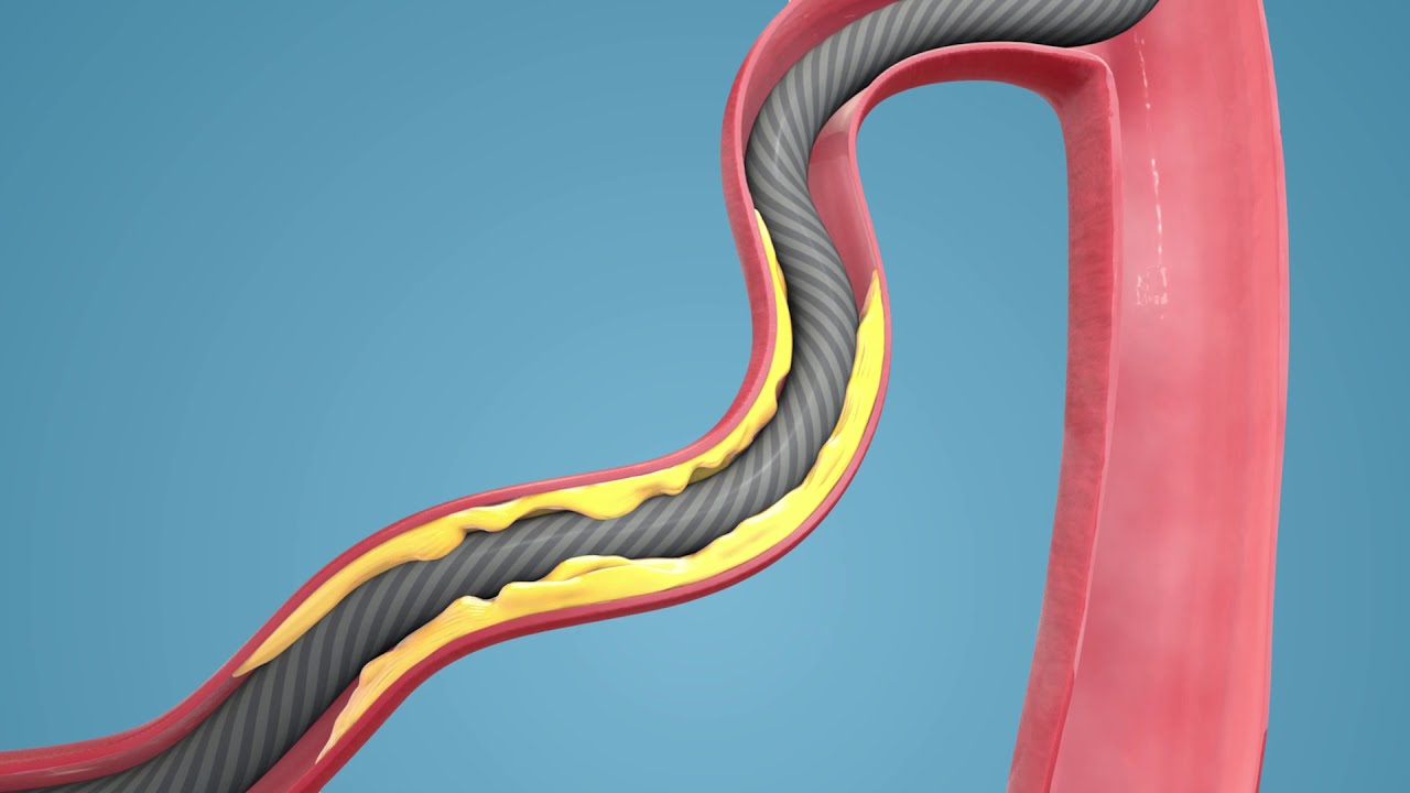 Turnpike® Catheters, Why Torque Matters