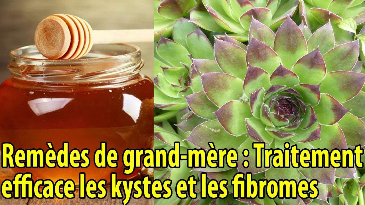Rem&egrave;des de grand-m&egrave;re : Traitement efficace les kystes et les fibromes - conseils