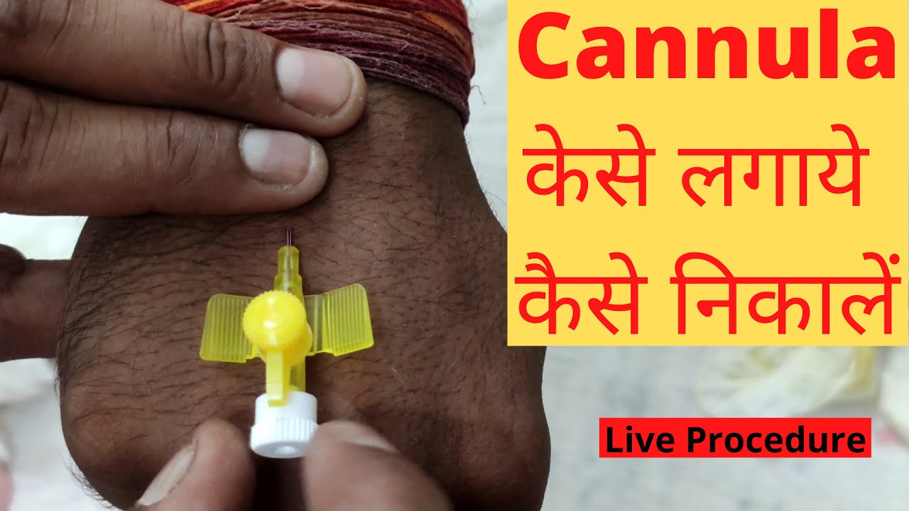 Cannula Kaise Lagate Hain | Kaise Nikale | Cannula Insertion Technique | Cannula Types | Hindi