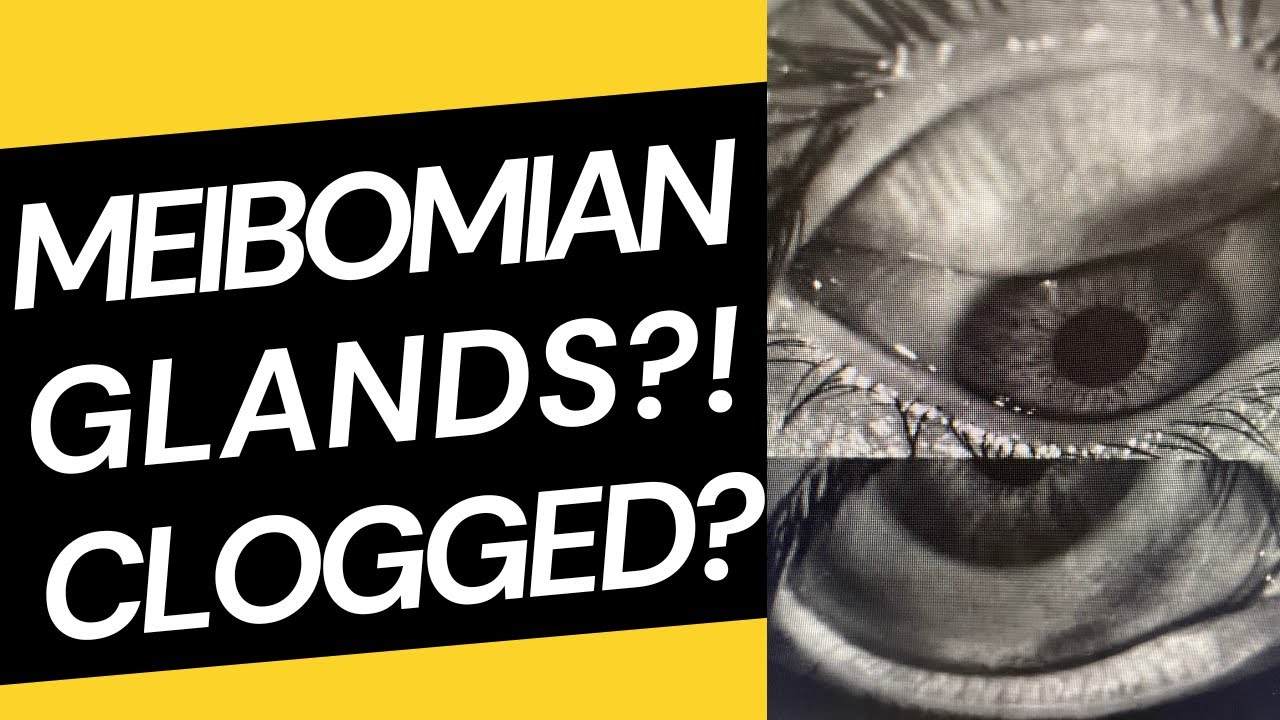 Are YOUR glands clogged? Meibomian gland disease | Meibomian gland dysfunction treatment