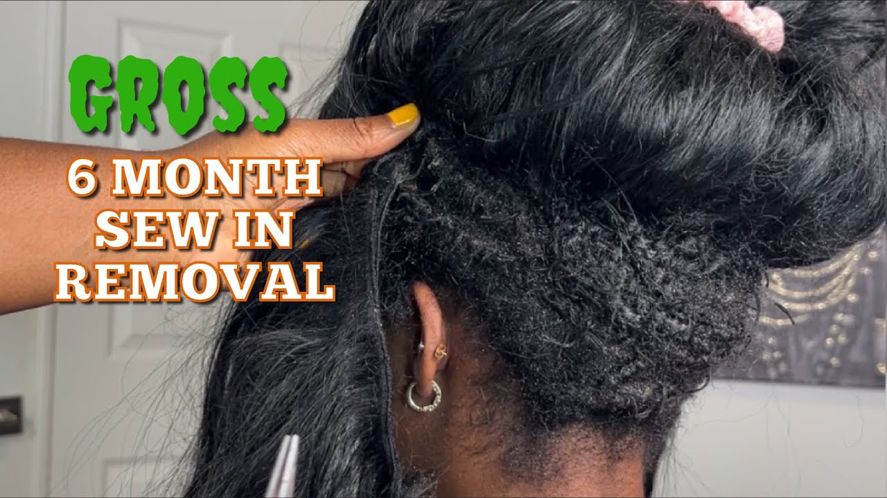 Gross 🤮   6 MONTH SEW IN REMOVAL | part 1