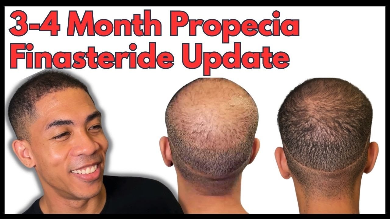 3-4 Month Before & After Propecia Update