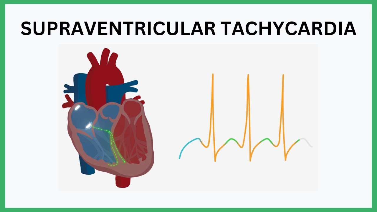 Supraventricular Tachycardia (SVT) Visualised
