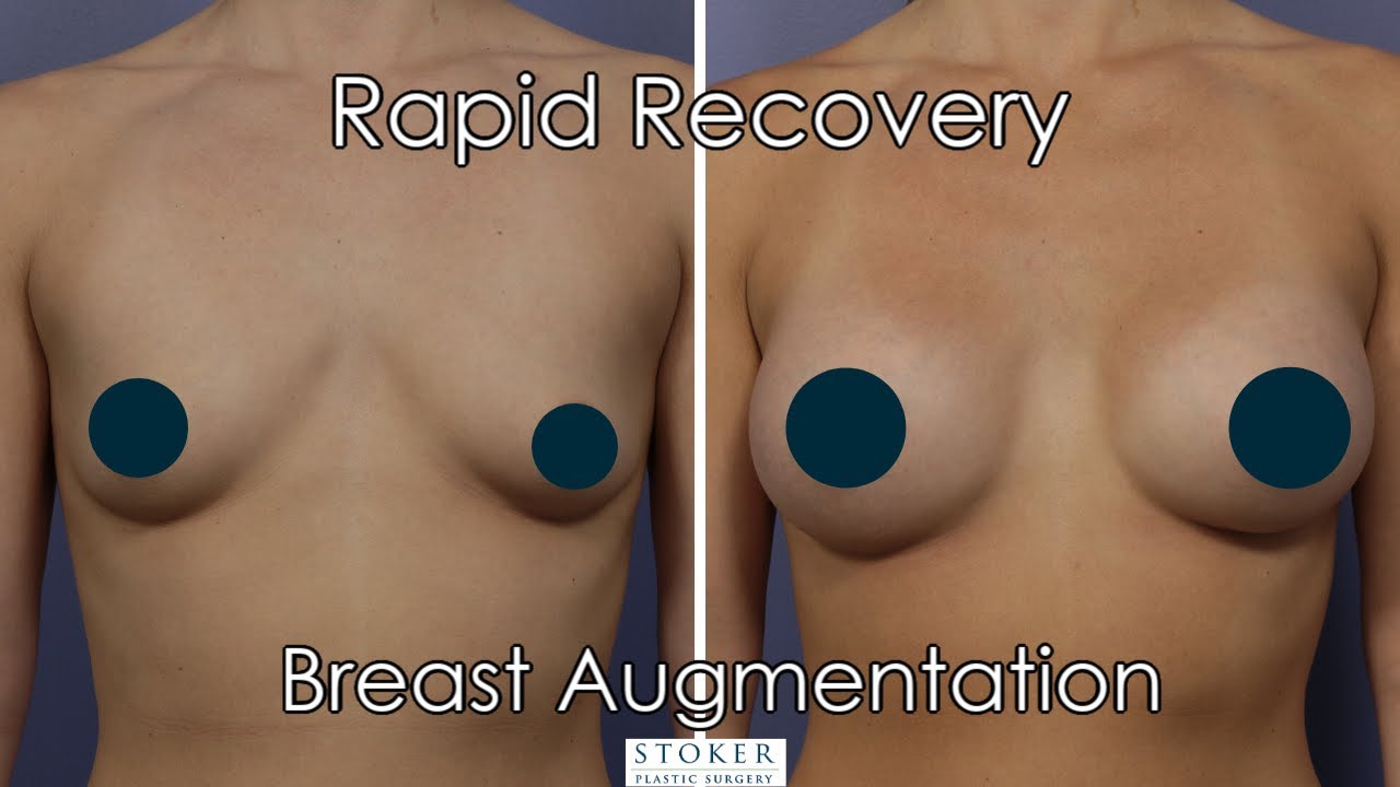 Rapid Recovery Breast Augmentation: Los Angeles Plastic Surgeon Dr. David Stoker Shares Technique