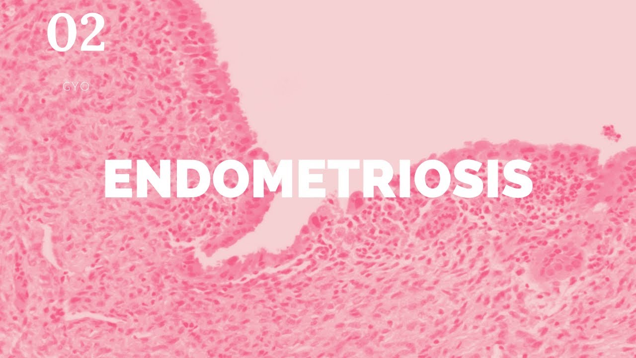 Endometriosis - ENARM