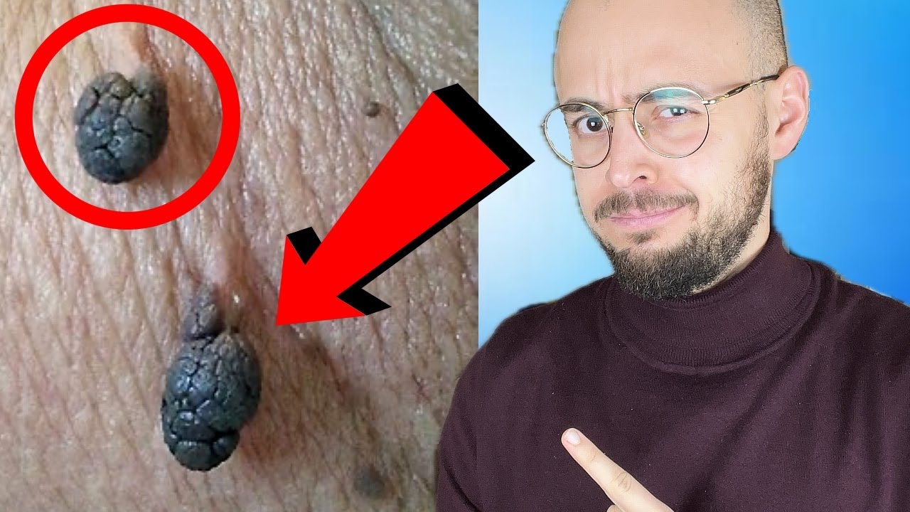 Comment les enlever ? M&eacute;thode maison simple et efficace