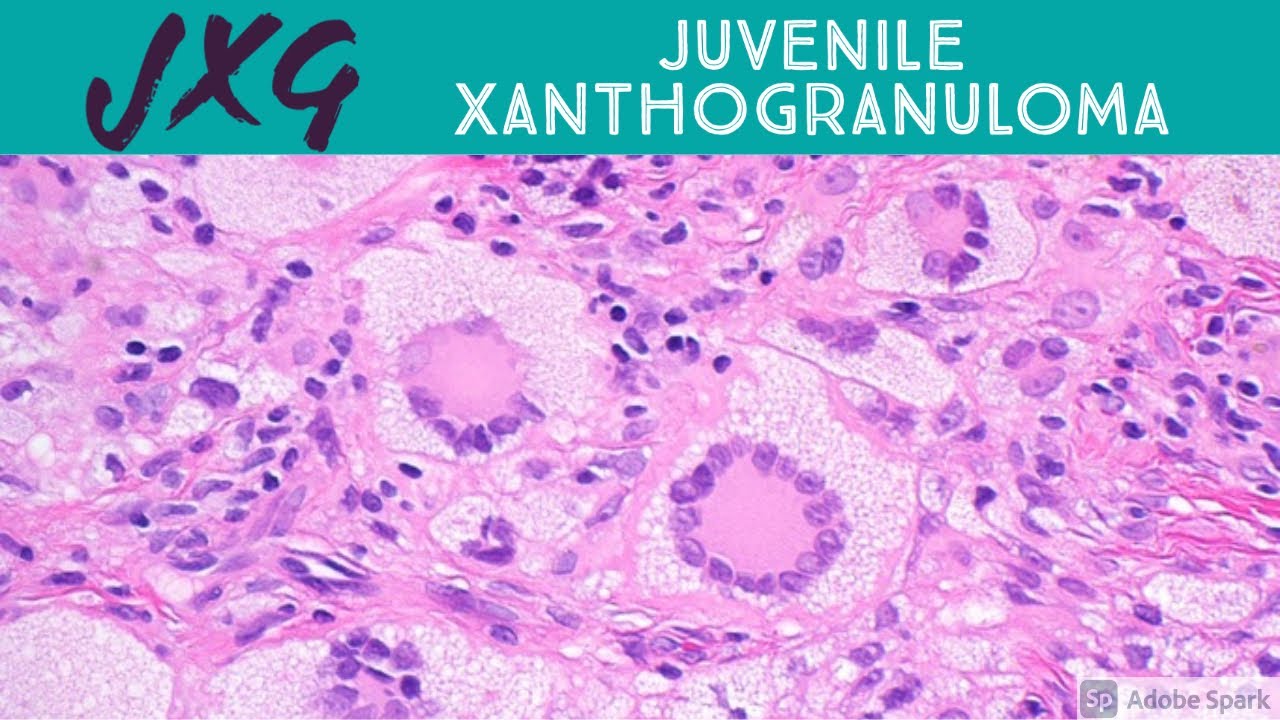 Juvenile Xanthogranuloma (JXG): 5-Minute Pathology Pearls for Dermatopathology & Dermatology