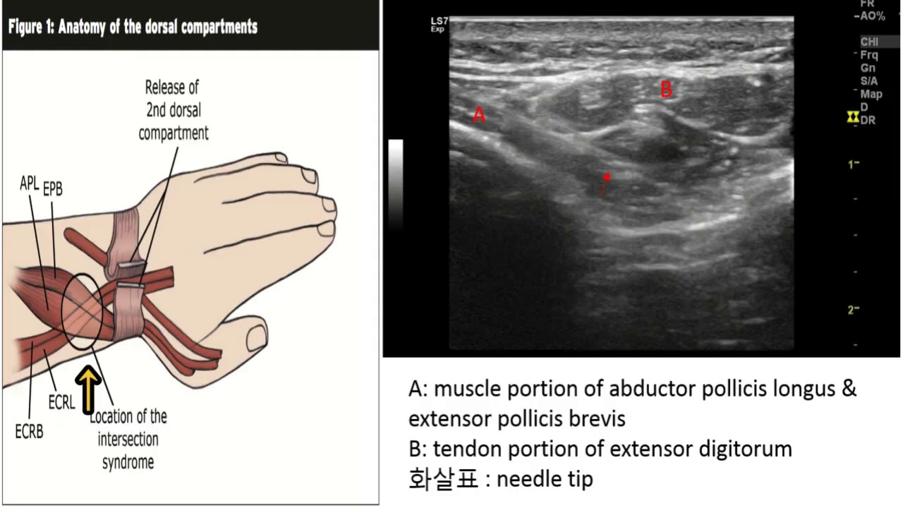 Treatment protocol for intersection syndrome