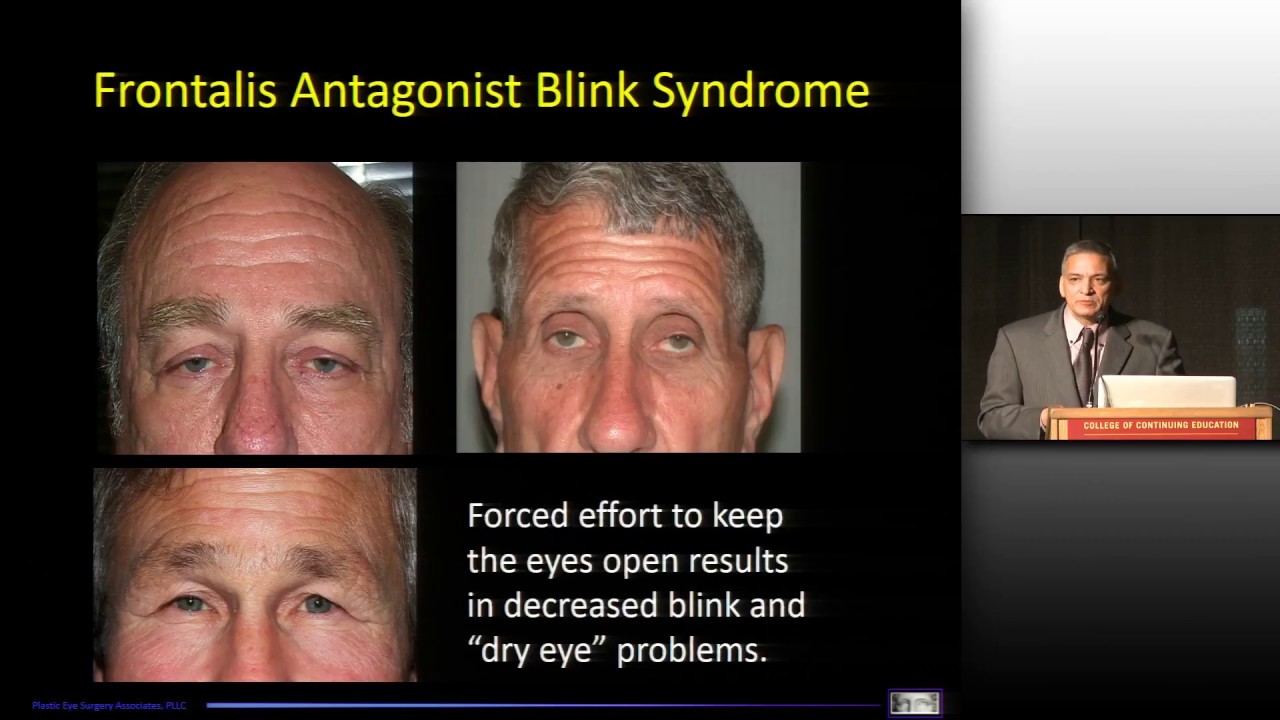 Blepharospasm & Dry Eye - Soparkar