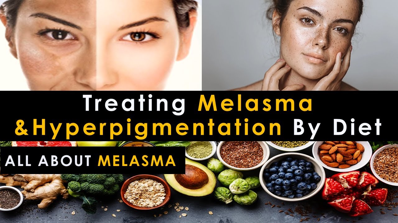 Melasma Cure Diet | Treat Melasma & HyperPigmentation By Diet | Treat Melasma Naturally
