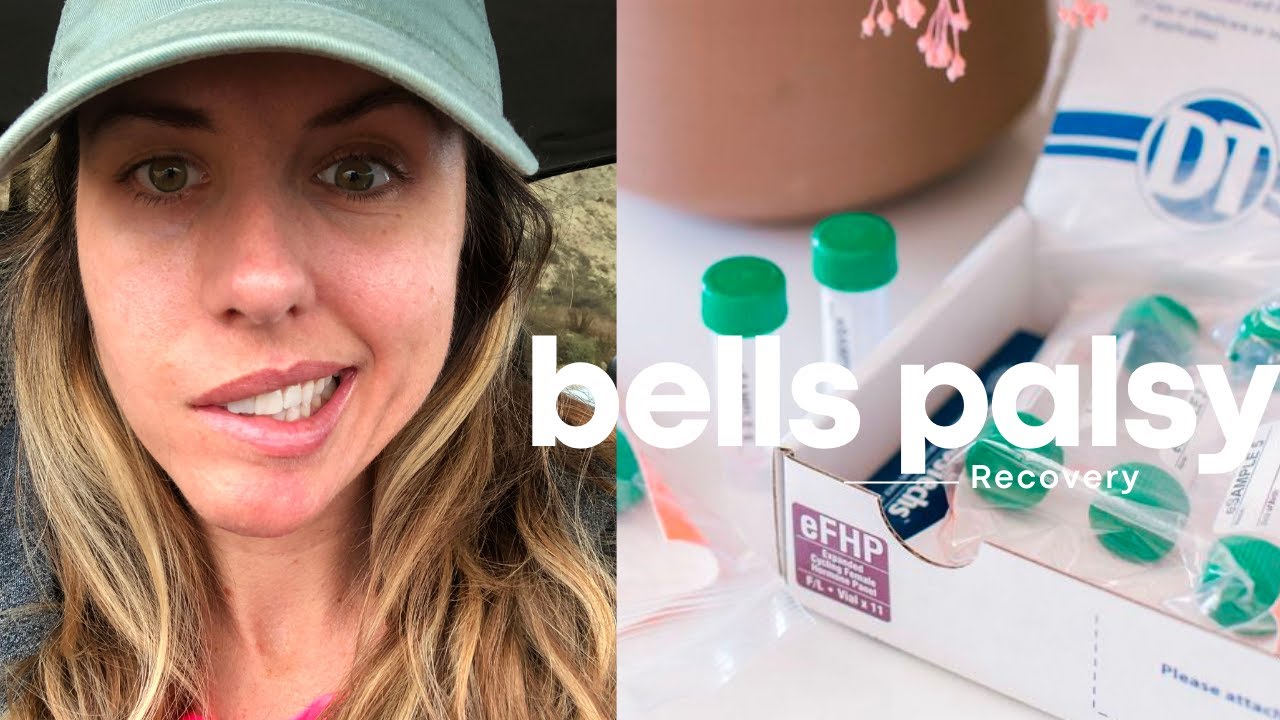 Bells Palsy | Recovery and Natural Remedies Days 1-7
