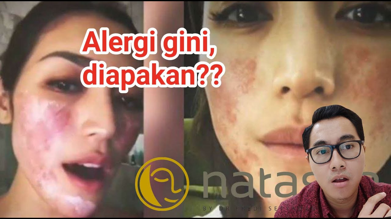 Nemu Alergi Ala Jessica Iskandar! Diapakan? | Kasus Langka di Natasha Sidoarjo