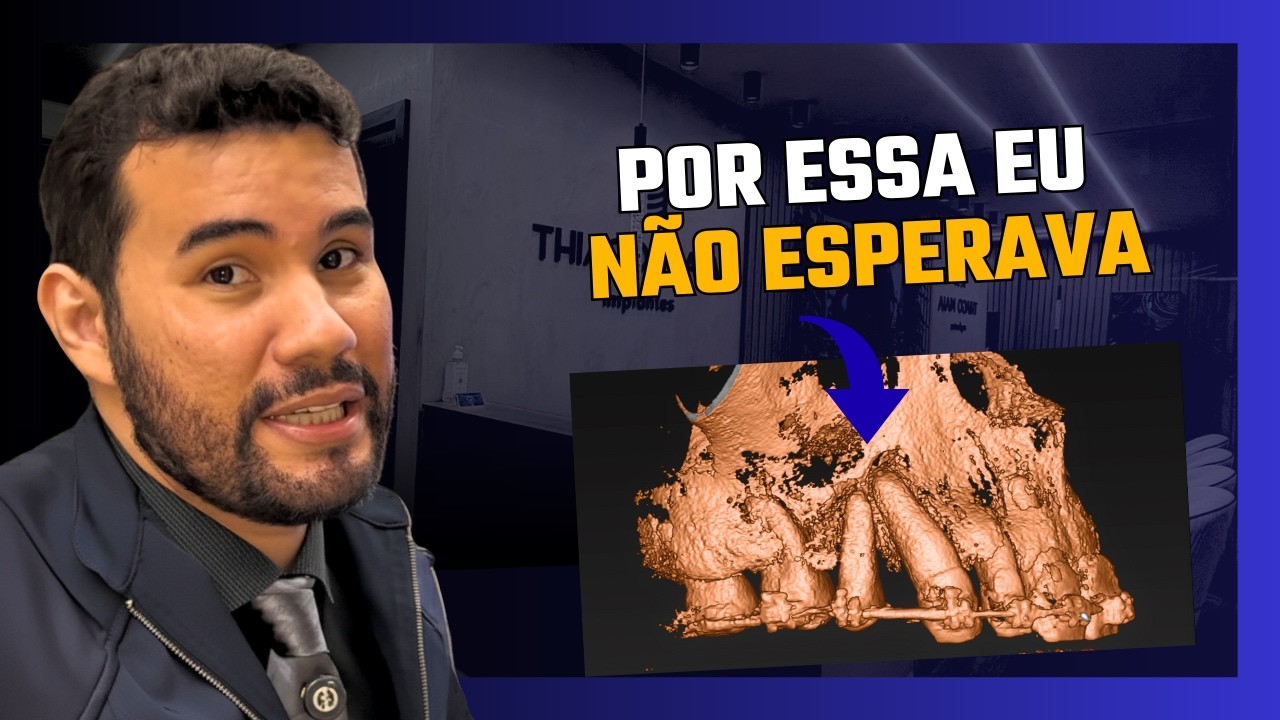 Esse IMPLANTE Daria Problema (E Quase Foi Feito)