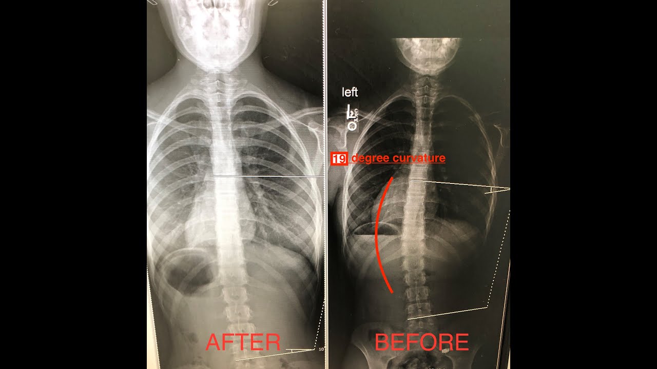 Video #13: Scoliosis Before and After Physical Therapy Treatment