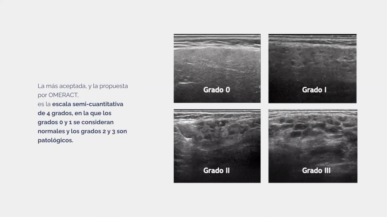 Caso clínico: Ecografía de glándula salival en el síndrome de Sjögren