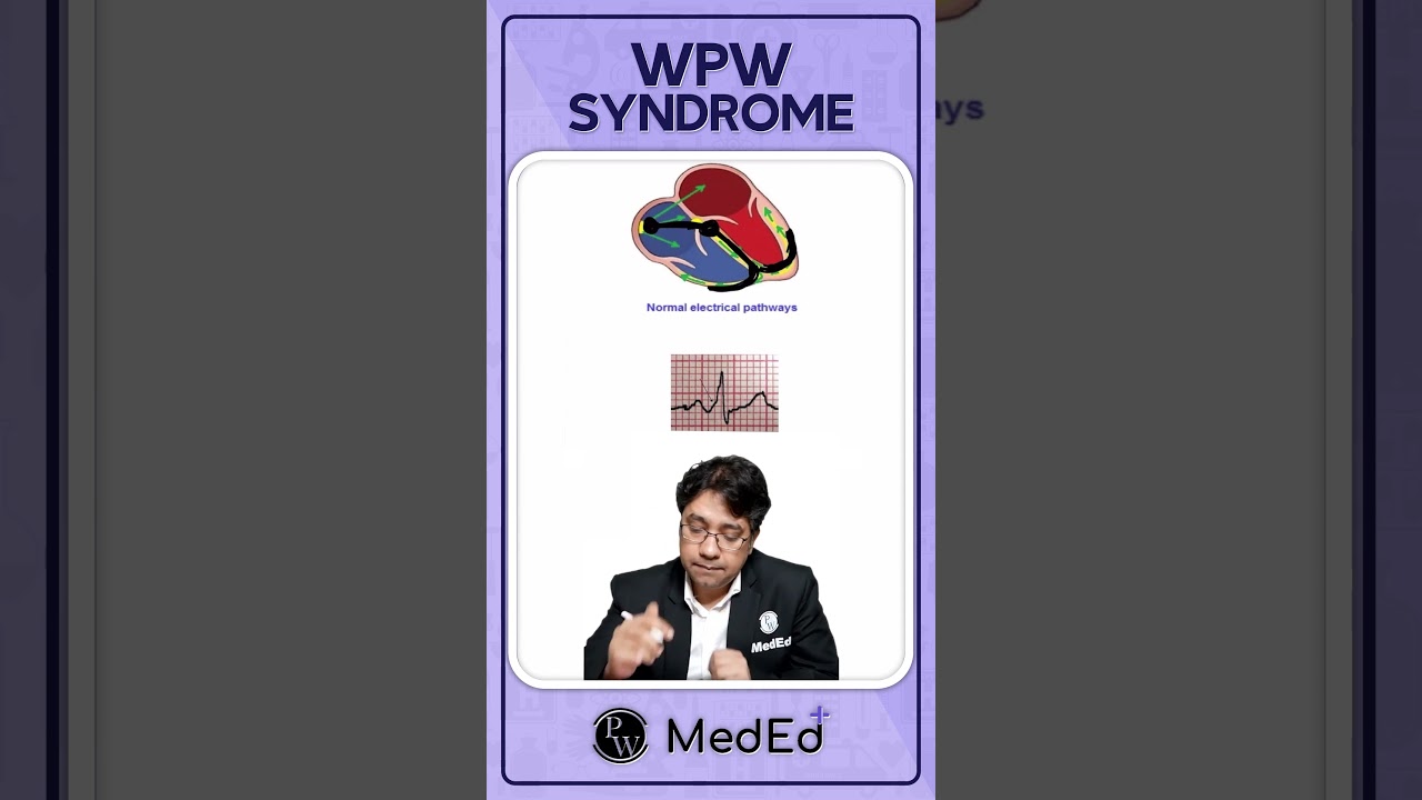 What is WPW Syndrome? #PW #MBBS #NEETPG