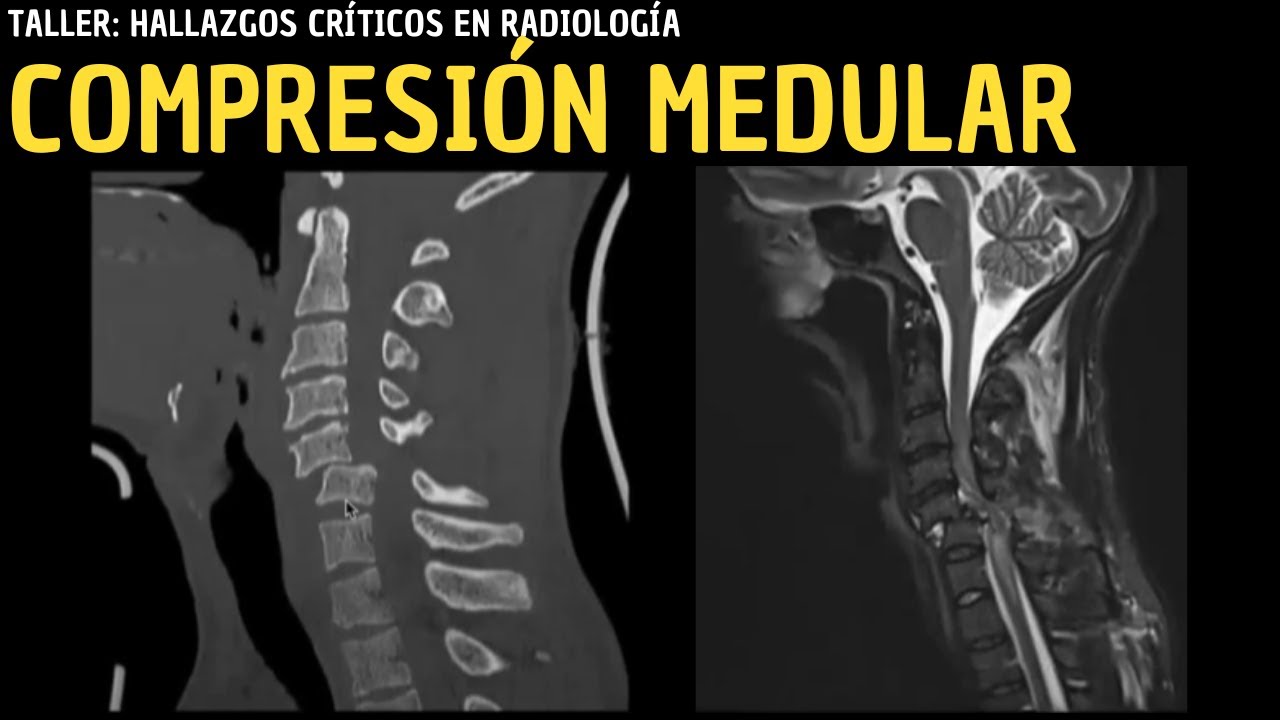 Taller Hallazgos Cr&iacute;ticos: Compresi&oacute;n medular