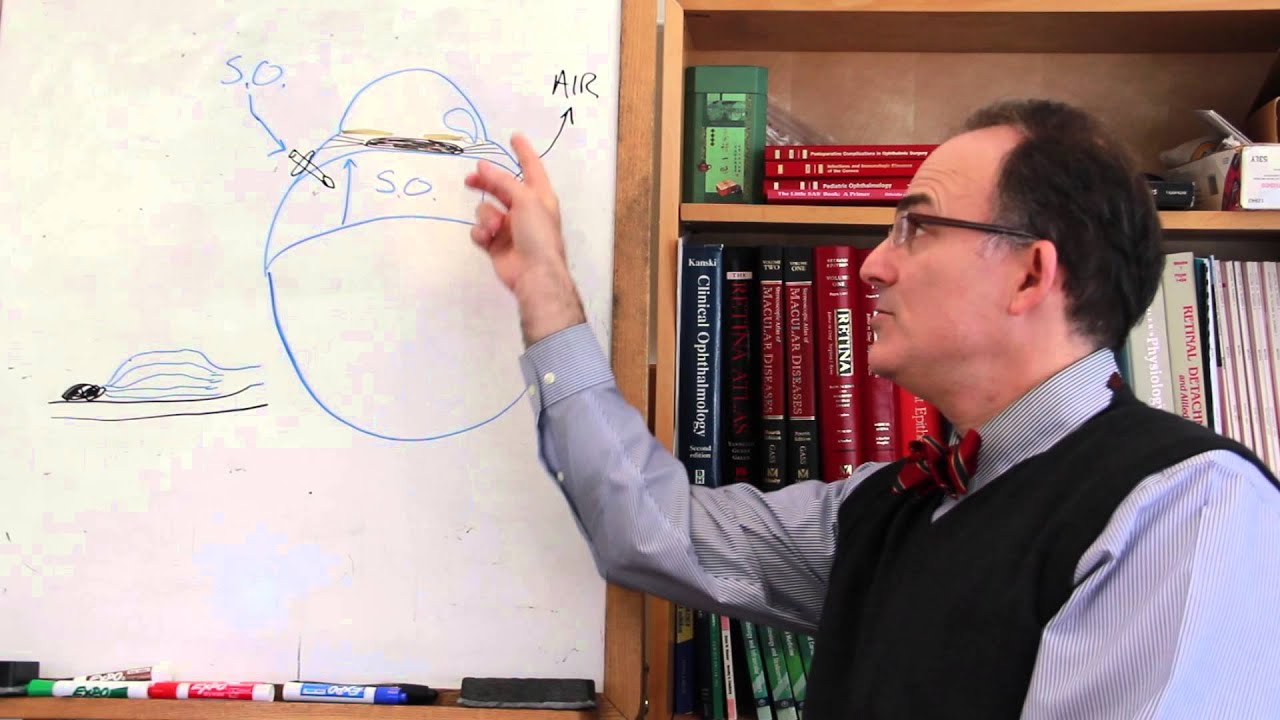 Why Does Silicone Oil Enter the Anterior Chamber?