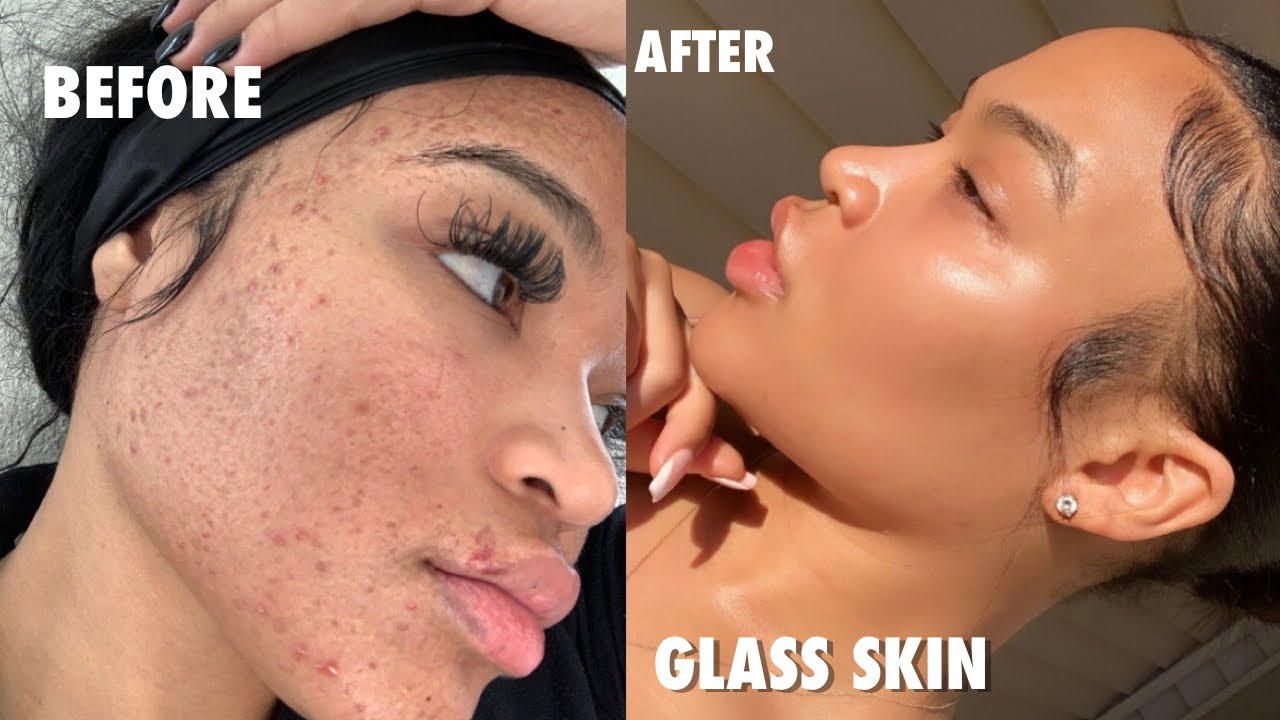 HOW I CLEARED MY ACNE FOR GOOD IN ONE WEEK (NO ACCUTANE) + SKINCARE GIVEAWAY | SKINCARE ROUTINE 2020