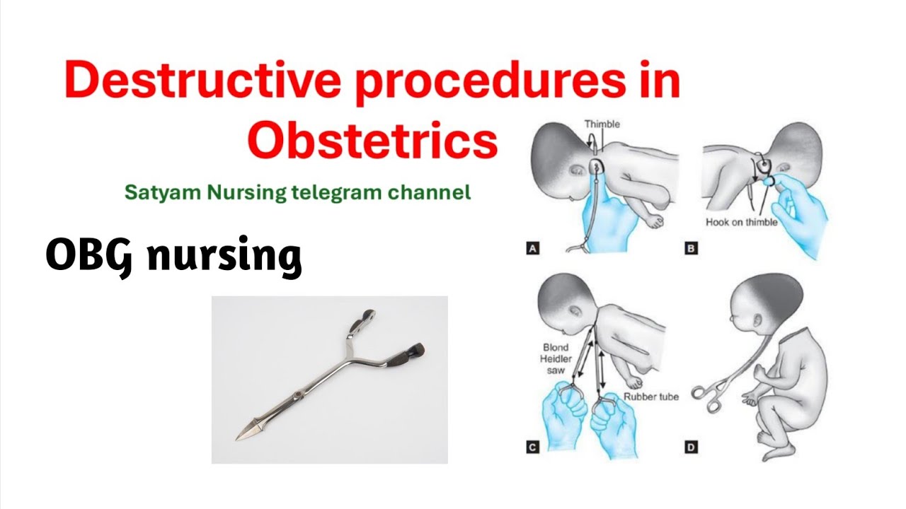 Destructive procedures in obstetrics | define destructive operations | obstetrics and gynecology